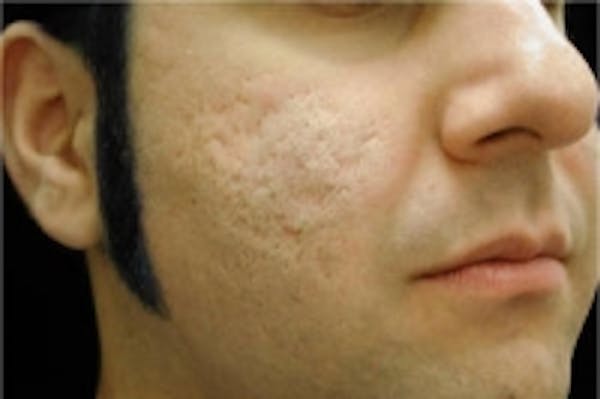 Acne Scarring Before & After Gallery - Patient 5930185 - Image 1