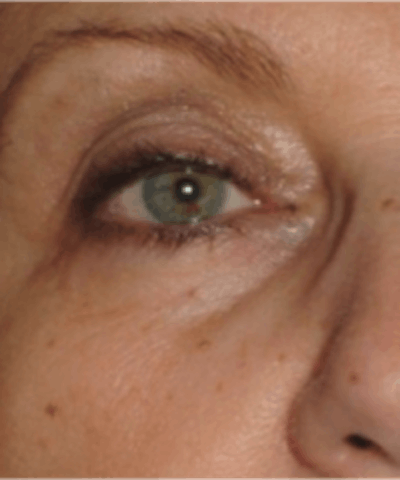 Eyelid Rejuvenation Gallery - Patient 5930187 - Image 1