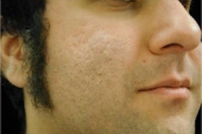 Acne Scarring Before & After Gallery - Patient 5930185 - Image 2