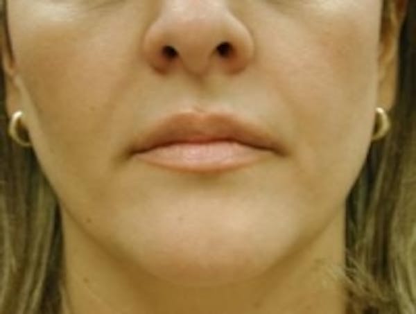 Fillers Before & After Gallery - Patient 5930186 - Image 2