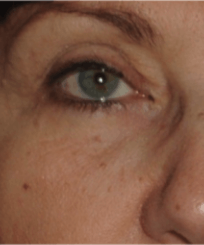 Eyelid Rejuvenation Gallery - Patient 5930187 - Image 2