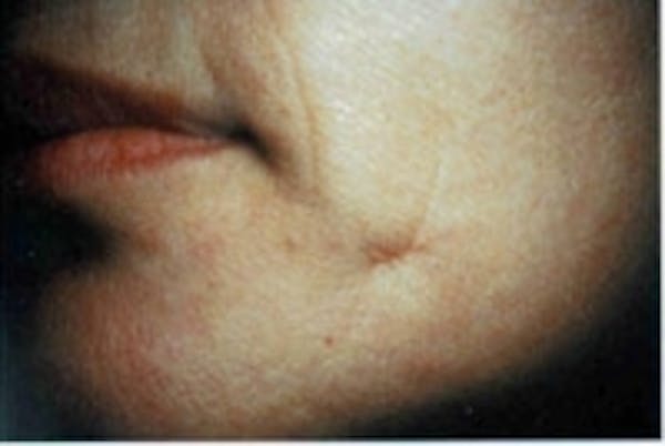 Acne Scarring Gallery - Patient 5930188 - Image 1