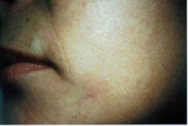Acne Scarring Before & After Gallery - Patient 5930188 - Image 2