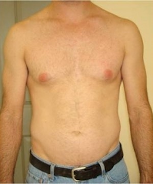 Before & After Laser Hair Removal in NYC at JUVA Skin & Laser Center