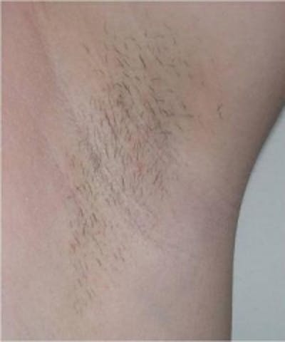 Laser Hair Removal Before & After Gallery - Patient 5930202 - Image 1