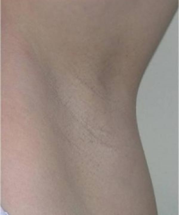 Laser Hair Removal Before & After Gallery - Patient 5930202 - Image 2