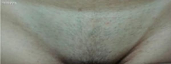 Laser Hair Removal Before & After Gallery - Patient 5930204 - Image 1
