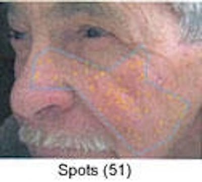 Sun Damage Before & After Gallery - Patient 5930207 - Image 1