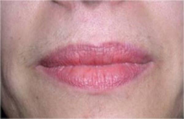 Laser Hair Removal Before & After Gallery - Patient 5930205 - Image 1