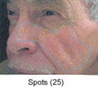 Sun Damage Before & After Gallery - Patient 5930207 - Image 2