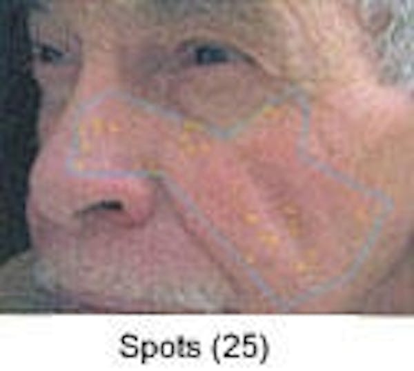 Sun Damage Before & After Gallery - Patient 5930207 - Image 2