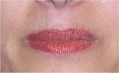 Laser Hair Removal Before & After Gallery - Patient 5930205 - Image 2