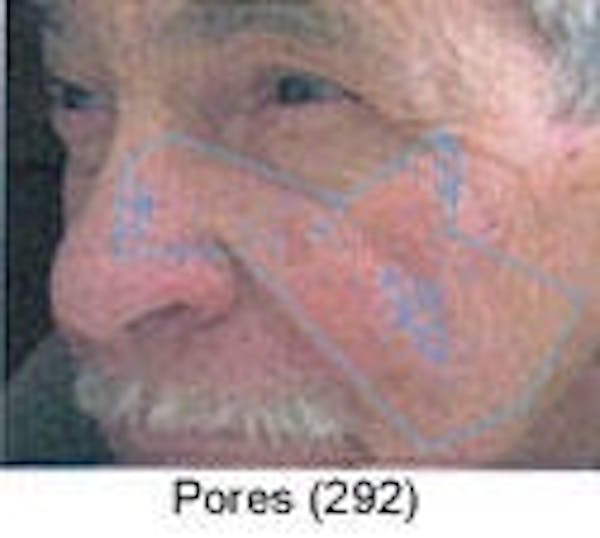Sun Damage Before & After Gallery - Patient 5930207 - Image 3