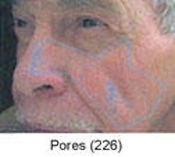 Sun Damage Before & After Gallery - Patient 5930207 - Image 4