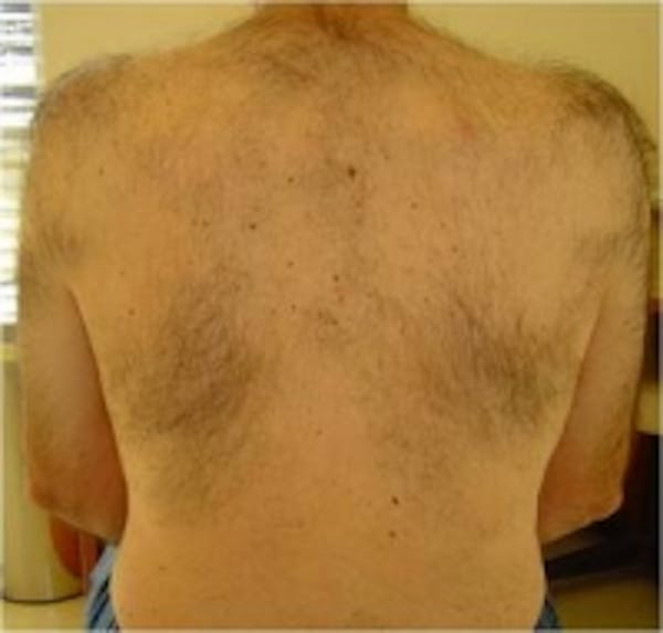 Laser Hair Removal Before & After Gallery - Patient 5930206 - Image 1