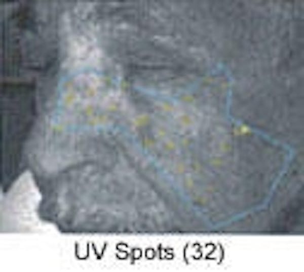 Sun Damage Before & After Gallery - Patient 5930207 - Image 5