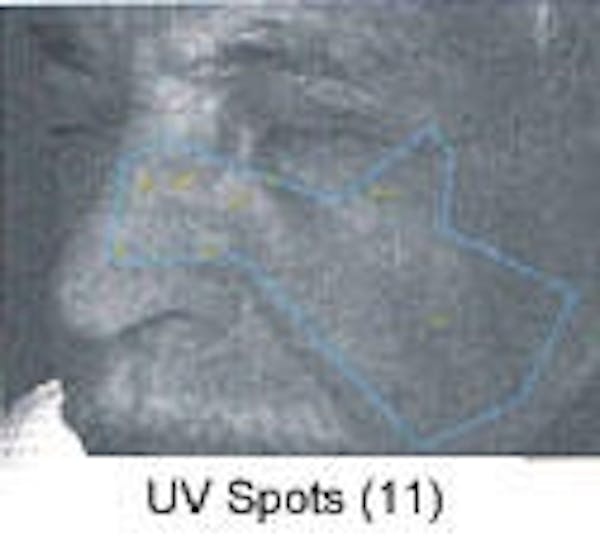 Sun Damage Before & After Gallery - Patient 5930207 - Image 6