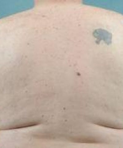 Laser Hair Removal Before & After Gallery - Patient 5930209 - Image 2