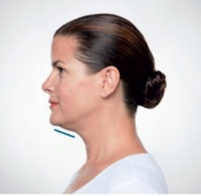 Non-Invasive Fat Removal Before & After Gallery - Patient 5930214 - Image 1