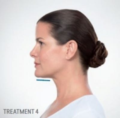 Non-Invasive Fat Removal Before & After Gallery - Patient 5930214 - Image 2