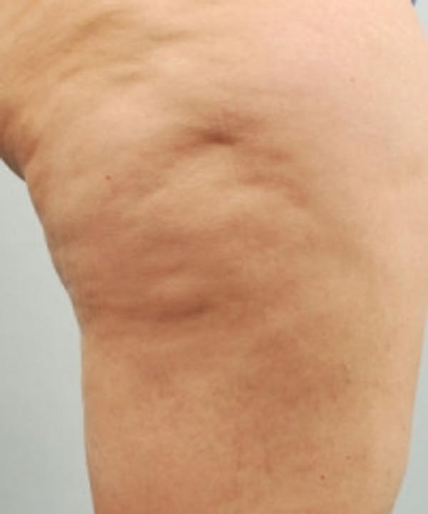 Cellulite Treatments Before & After Gallery - Patient 5930218 - Image 1
