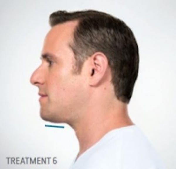 Non-Invasive Fat Removal Gallery - Patient 5930217 - Image 2
