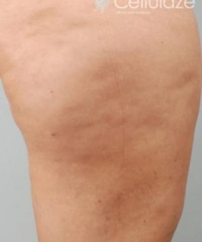 Cellulite Treatments Before & After Gallery - Patient 5930218 - Image 2