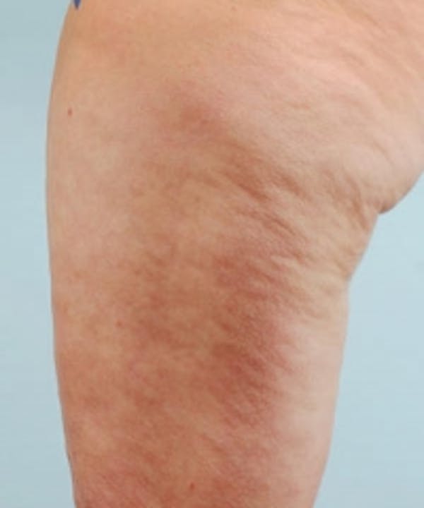 Cellulite Treatments Before & After Gallery - Patient 5930224 - Image 1