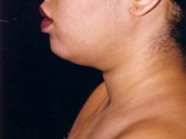 SmartLipo Before & After Gallery - Patient 5930225 - Image 1