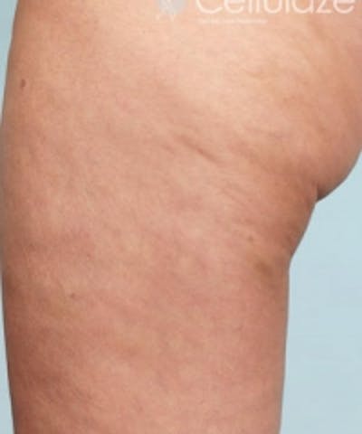 Cellulite Treatments Before & After Gallery - Patient 5930224 - Image 2