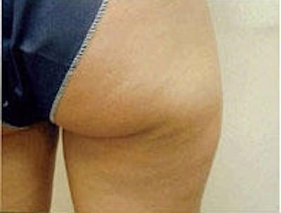 Cellulite Treatments Before & After Gallery - Patient 5930231 - Image 1