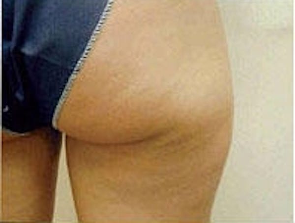 Cellulite Treatments Before & After Gallery - Patient 5930231 - Image 1
