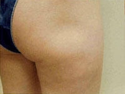 Cellulite Treatments Before & After Gallery - Patient 5930231 - Image 2