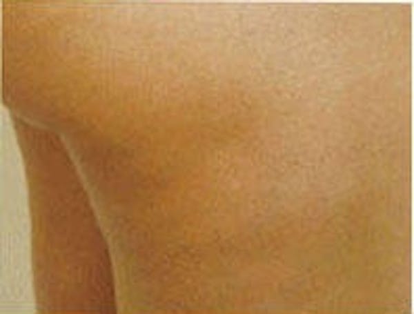 Cellulite Treatments Before & After Gallery - Patient 5930231 - Image 3