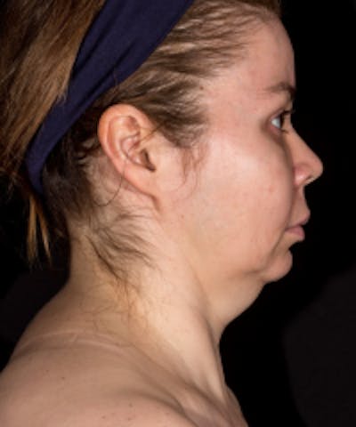 Non-Invasive Fat Removal Before & After Gallery - Patient 5930234 - Image 1