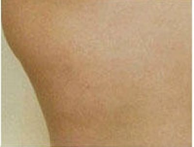 Cellulite Treatments Before & After Gallery - Patient 5930231 - Image 4