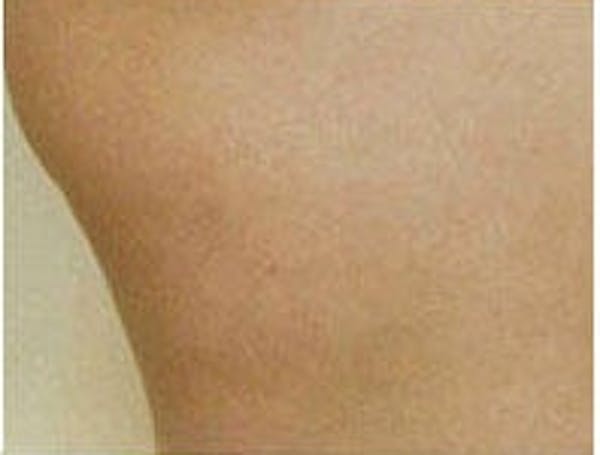 Cellulite Treatments Before & After Gallery - Patient 5930231 - Image 4