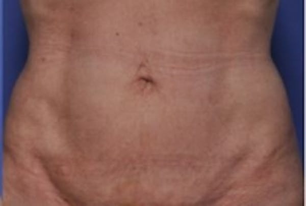 Skin Tightening Before & After Gallery - Patient 5930232 - Image 2