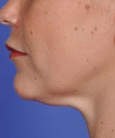 Skin Tightening Before & After Gallery - Patient 5930237 - Image 1