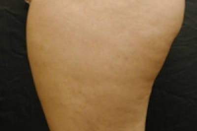 Cellulite Treatments Before & After Gallery - Patient 5930235 - Image 2