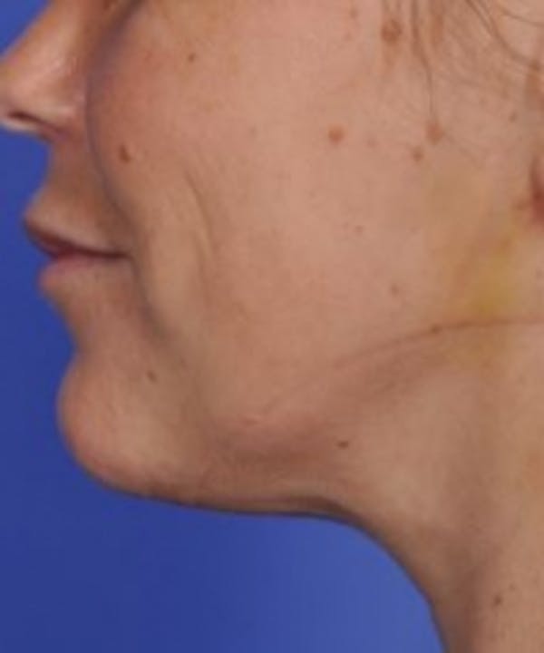 Skin Tightening Before & After Gallery - Patient 5930237 - Image 2