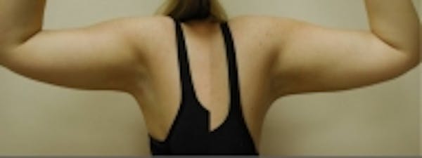 SmartLipo Before & After Gallery - Patient 5930236 - Image 2
