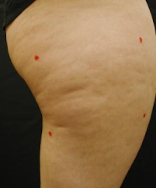 Cellulite Treatments Before & After Gallery - Patient 5930240 - Image 1