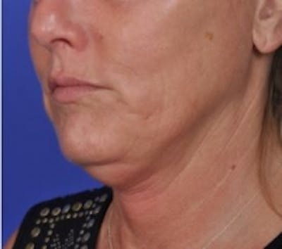 Skin Tightening Before & After Gallery - Patient 5930241 - Image 1