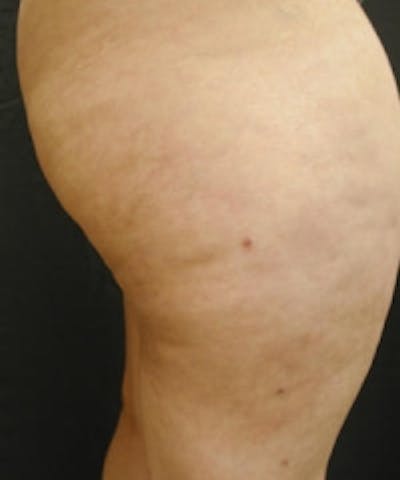 Cellulite Treatments Before & After Gallery - Patient 5930240 - Image 2