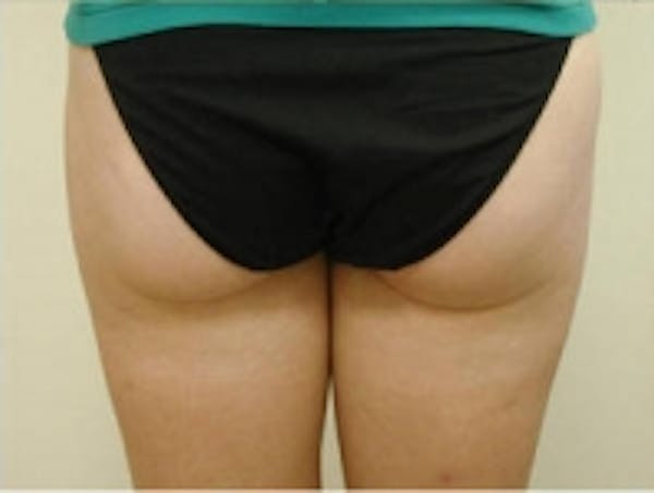 SmartLipo Before & After Gallery - Patient 5930244 - Image 2