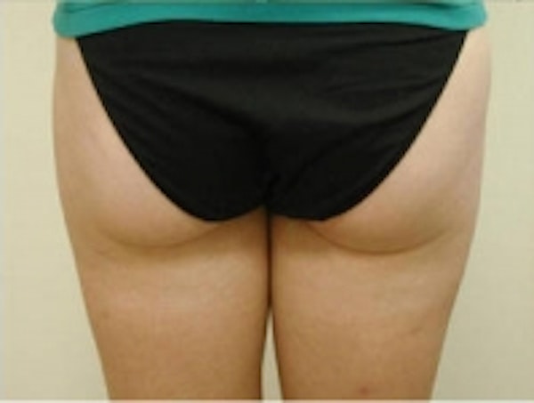 Before and after SmartLipo in NYC at JUVA Skin & Laser Center