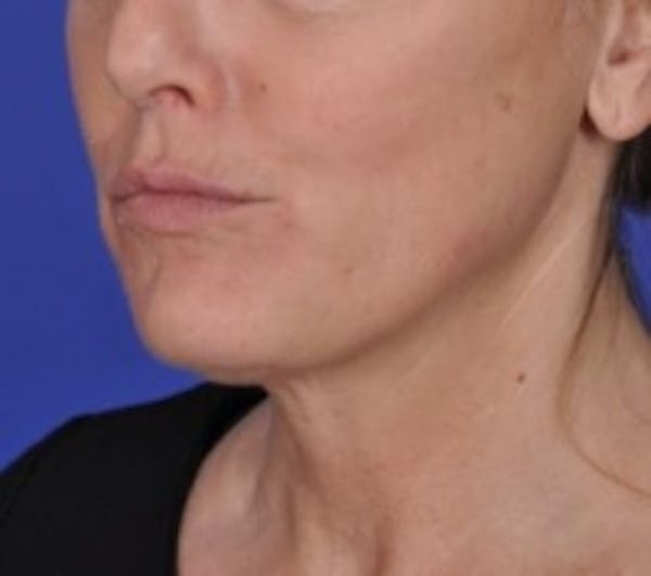 Skin Tightening Before & After Gallery - Patient 5930241 - Image 2