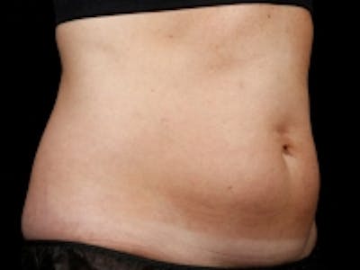 Non-Invasive Fat Removal Before & After Gallery - Patient 5930243 - Image 1