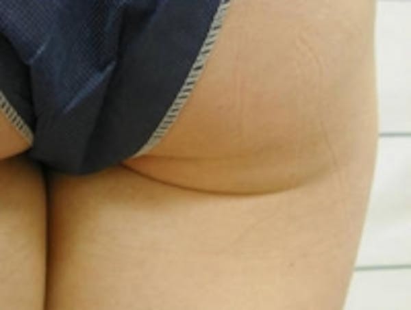 SmartLipo Before & After Gallery - Patient 5930244 - Image 3